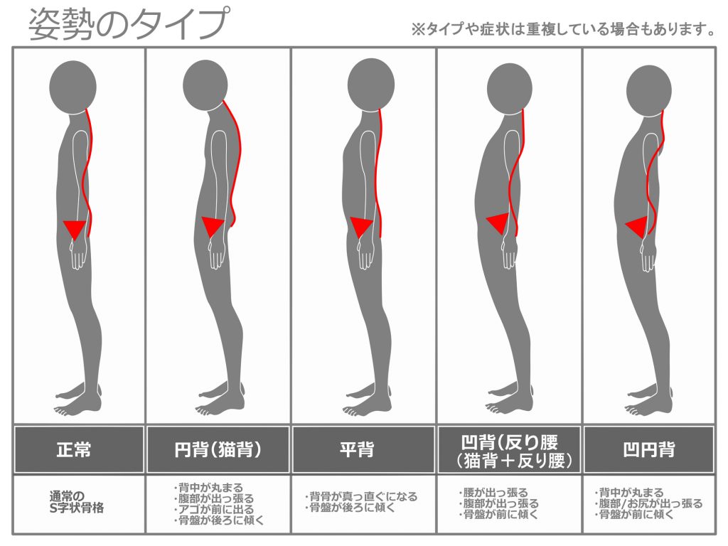 姿勢のタイプ ※タイプや症状は重複している場合もあります。　正常通常のS字状骨格　円背（猫背）・背中が丸まる・腹部が出っ張る・アゴが前に出る・骨盤が後ろに傾く　平背・背骨が真っ直ぐになる・骨盤が後ろに傾く　凹背（反り腰（猫背+反り腰））・腰が出っ張る・腹部がでっぱる・骨盤が前に傾く　凹円背・背中が丸まる・腹部/お尻が出っ張る・骨盤が前に傾く